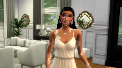 Vitiligo nu beschikbaar in De Sims 4